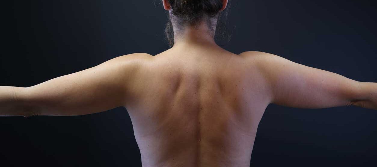 patient with arm liposuction treatment