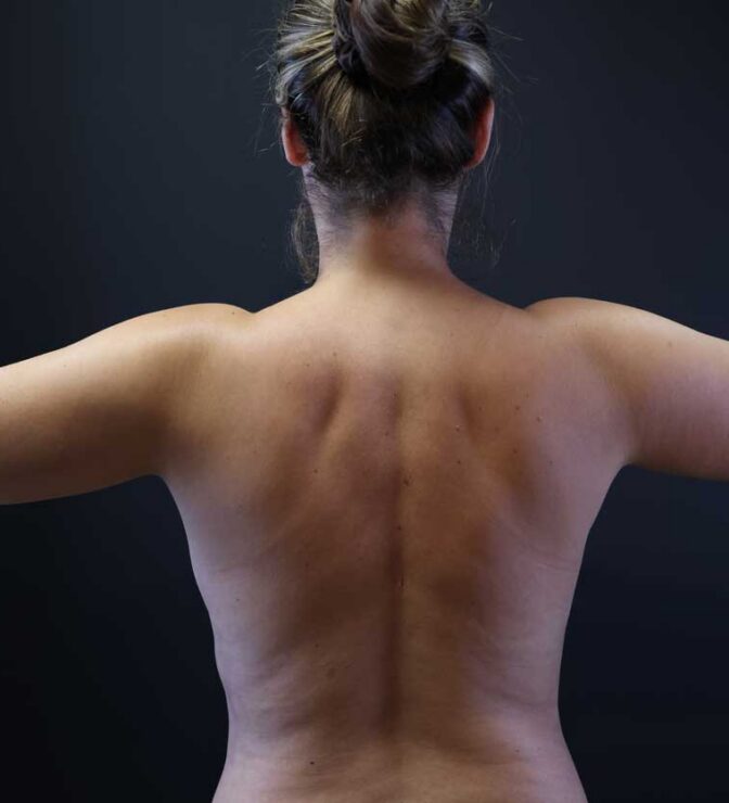patient with arm liposuction treatment